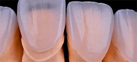 Виниры